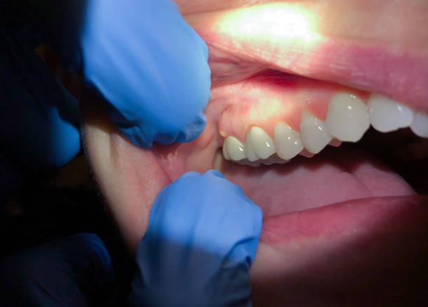 Best Broken Tooth Emergency  in Lauderdale Lakes, FL